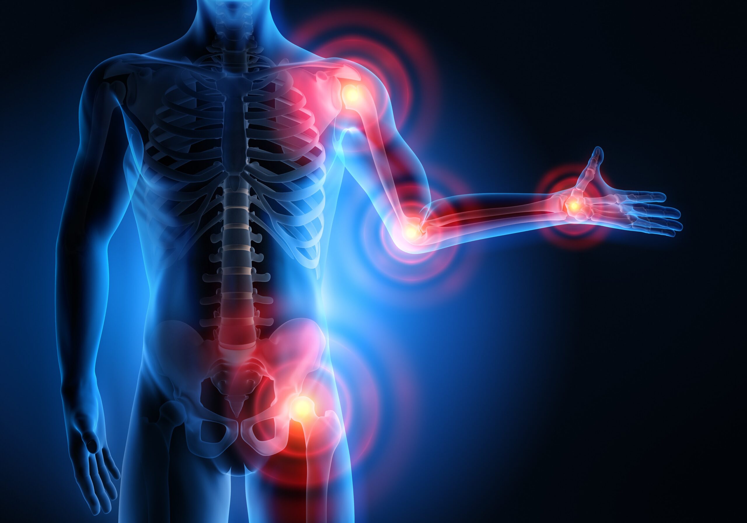 Artrite, Artrose, Lesão Articular? Descubra os benefícios do Colágeno Tipo ll
